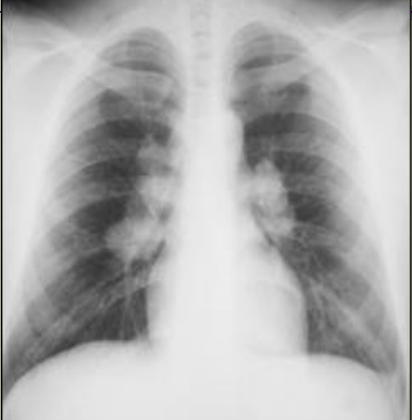 Adenopathy